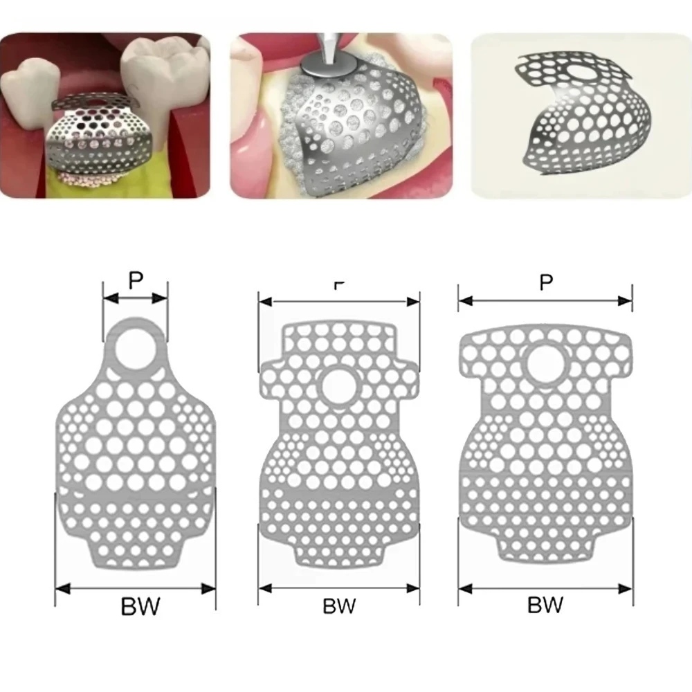 Dental OB2 GBR 3D Titanium Mesh Guided Bone Regeneration Membrane Plate for Implant Bone Formation And Incremental SmartBuilder