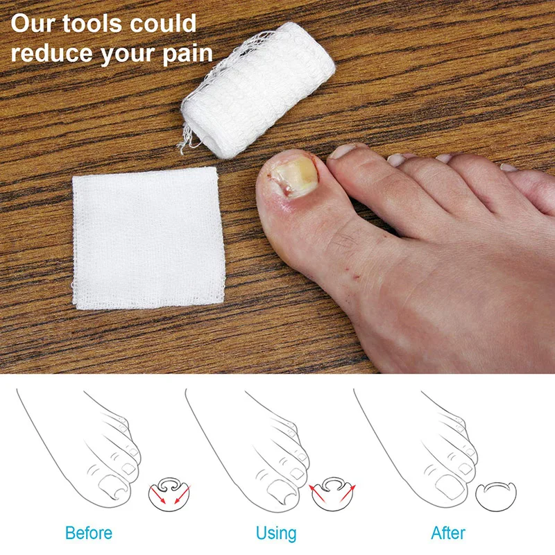 Stainless Steel Ingrown Toenails Corrector Orthoti Nail Straightening Tool Relief Pain Pedicure Tool For Ingrown Toenail Recover