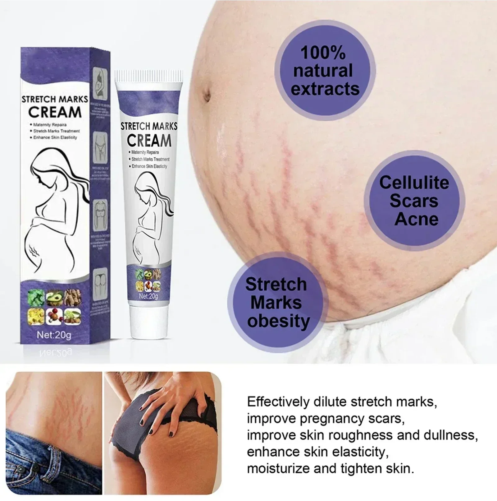 Stretch Mark Removal Cream For Pregnant Women Postpartum Repair Of Thigh Fat Lines Growth Mark Removal Cream