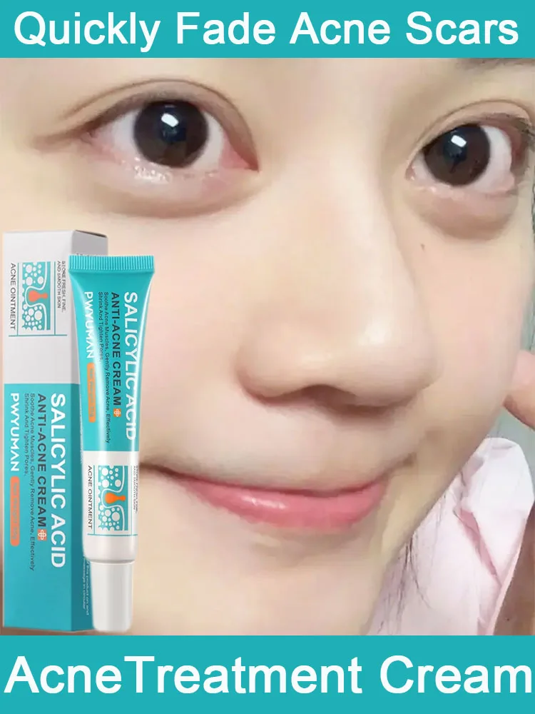 Salicylic Acid Acne…