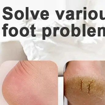 Elektrische voet eeltverwijderaar Voetverzorgingsvijlhulpmiddel Beenhakken Verwijder dode huid Pedicure gereedschapsset en vervangend schuurpapier