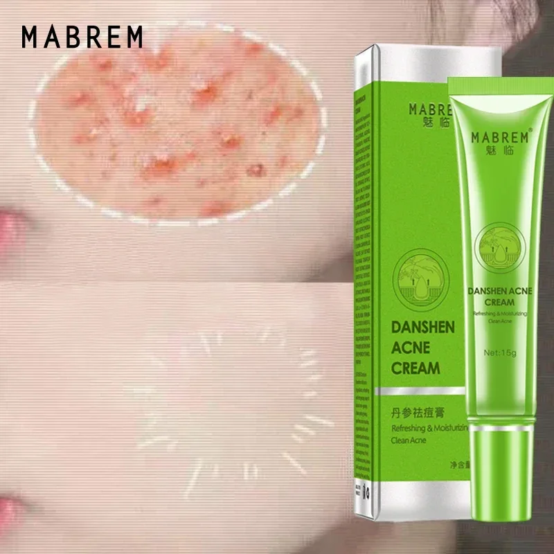 MABREM Anti-acne Cream Herbal Pimple Removal Repair Treatment damaged skin Acne Damaged Fade Acne Marks Extract Mild Skin Care
