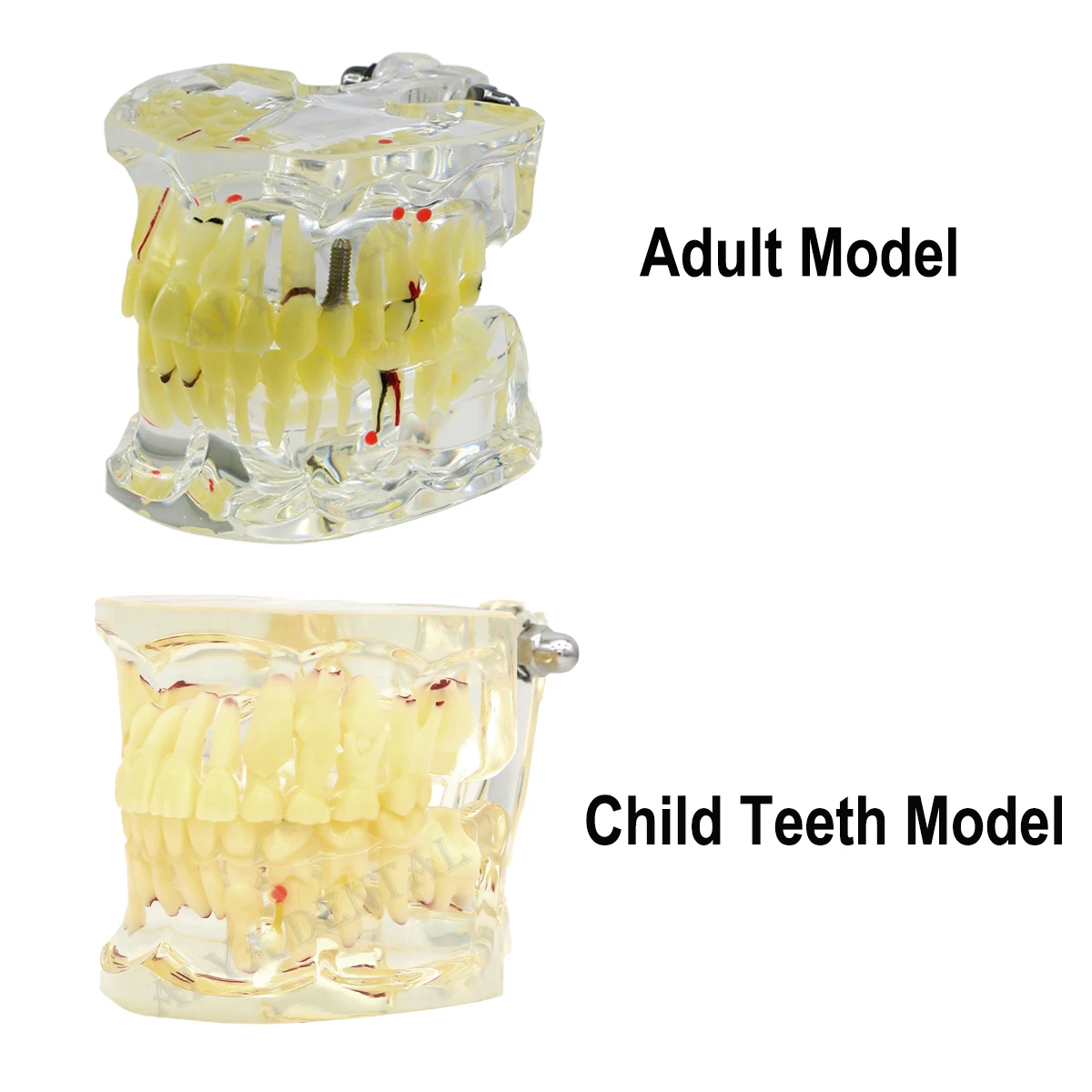 

Dental Disease Implant Teeth Model Dental Child Teeth Model Dentist Student Models For Dentistry Practice Training