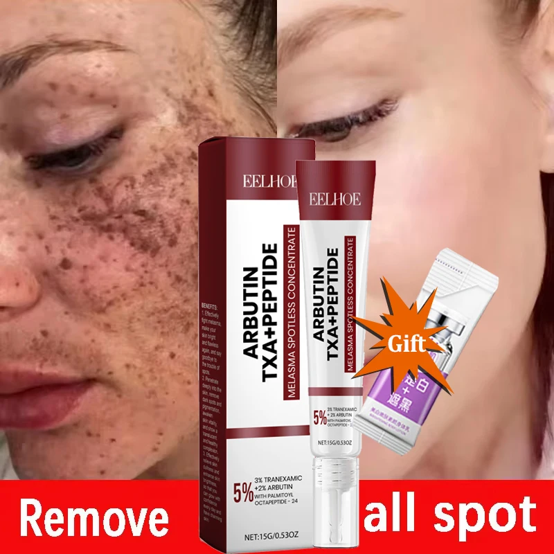 

Whitening Freckle Cream Remove Dark Spots Anti Freckle Face Creams Niacinamide Fade Pigmentation Melasma Brighten Skin Care 20g