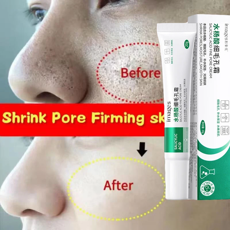 Crème de traitement à l'acide salicylique pour resserrer les pores, éliminer les points noirs, les marques d'acné et les pores dilatés – Produits pour la peau du visage 1 Crème de traitement à l'acide salicylique pour resserrer les pores, éliminer les points noirs, les marques d'acné et les pores dilatés – Produits pour la peau du visage 1