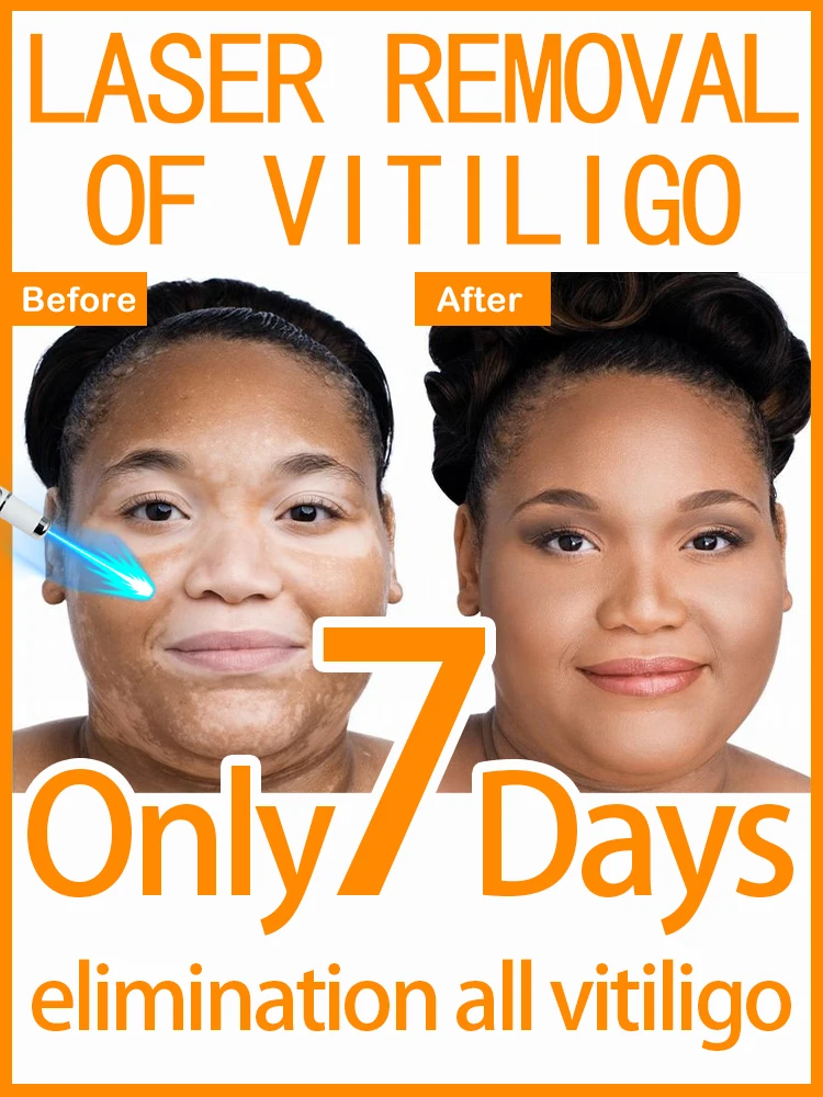 

Vitiligo быстро улучшает белые пятна