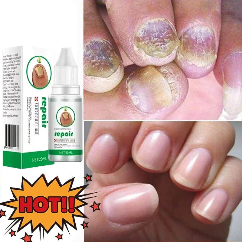 Fungal Nail Treatment Oil Foot Repair Essence Toe Nail Fungus Removal Gel Anti Infection Cream Fungal Nail Removal Paronychia