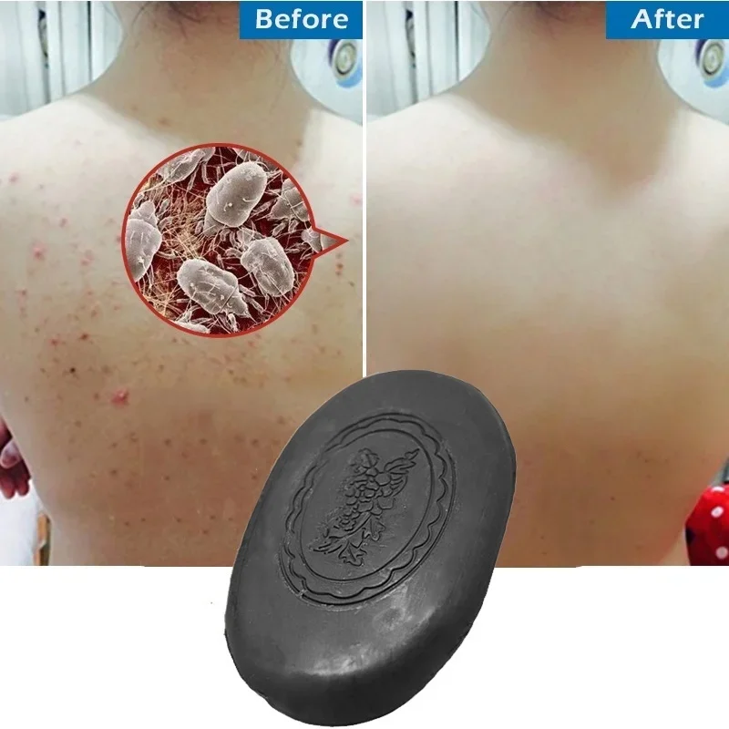 

Bamboo Charcoal Washing Soap for Remove Body Acne Clean Face and Body Skin Care Whiting Soap