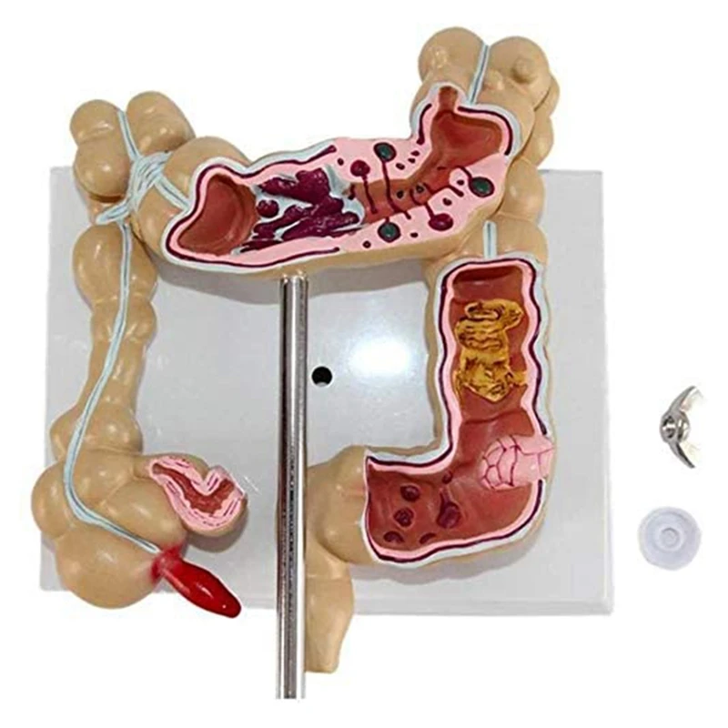 Colon Pathological Colorectal Cancer Model Large Intestine Model Gastrointestinal Anatomical Model