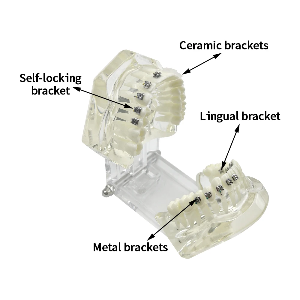 With 4 kinds Brackets Dental Orthodontic Model Metal Self-ligating bracket Ligating Braces Standard Demo Resin Comparison Model