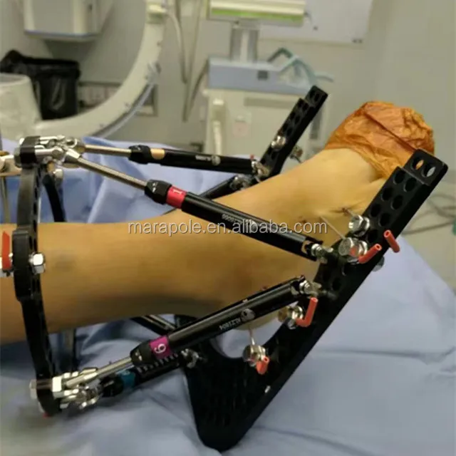 The Taylor SPATIAL FRAME for External fixation