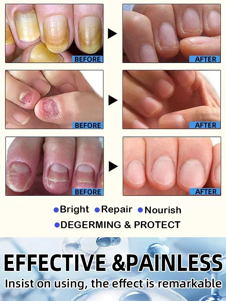 Problèmes d'ongles des pieds entièrement résolus