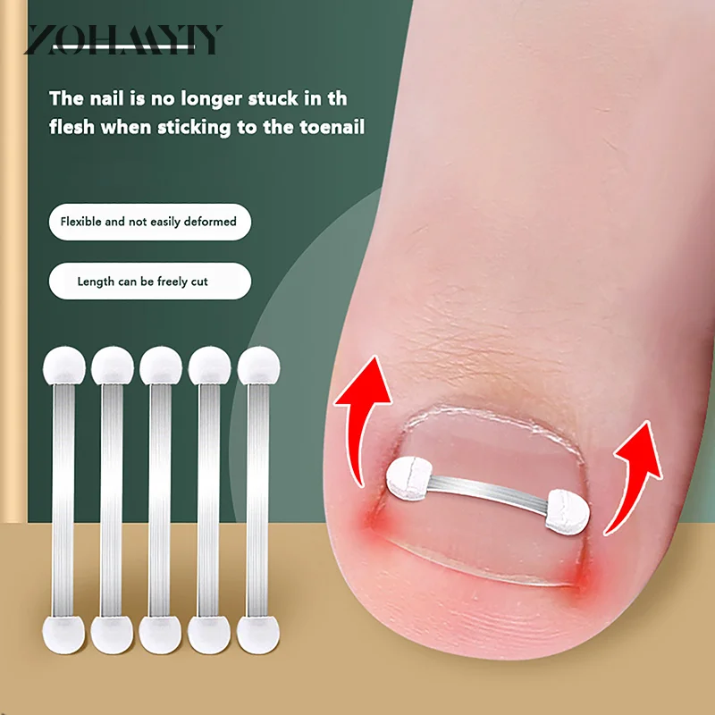 Ingrown Corrector unha para pedicure, Incorporar Toe Nail Treatment, Correção de unha engrown profissional, Pé Care Tool