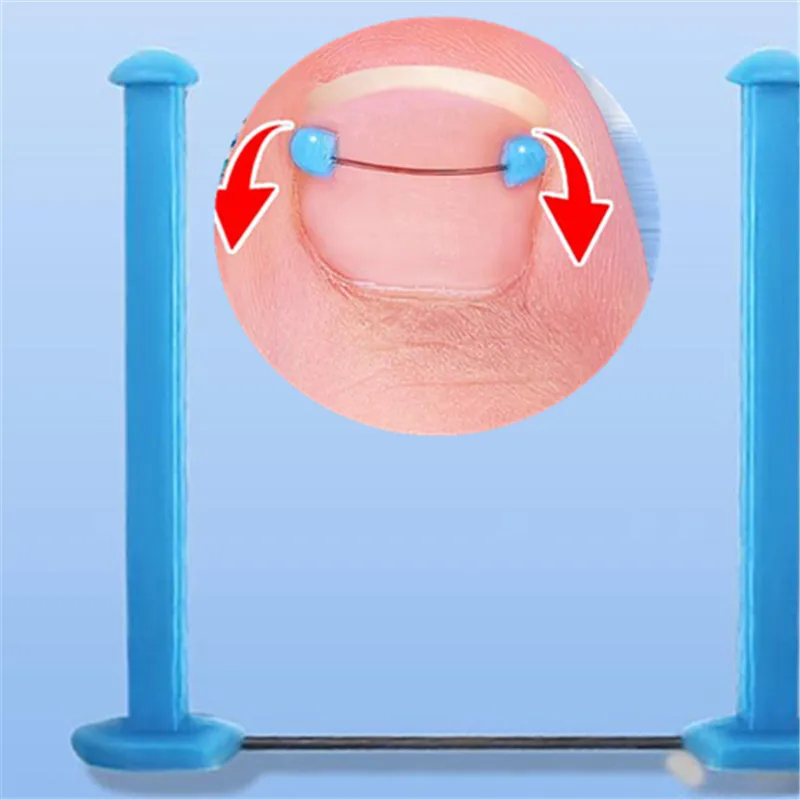 6pcs Ingrown Toenail Blue Correction Wire Set Foot Care Tools Professional Treatment Recover Embed Toe Nail Straightening Toe