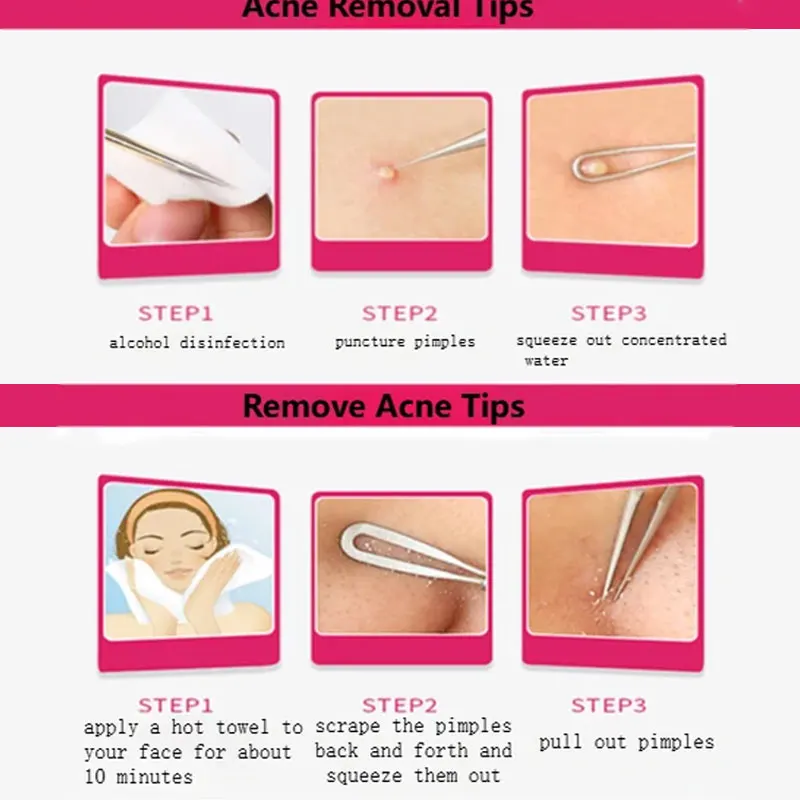 Profissional de aço inoxidável ferramenta removedor cravo comedone acne espinha agulhas extrator mancha removedor pele rosto cuidados ferramenta