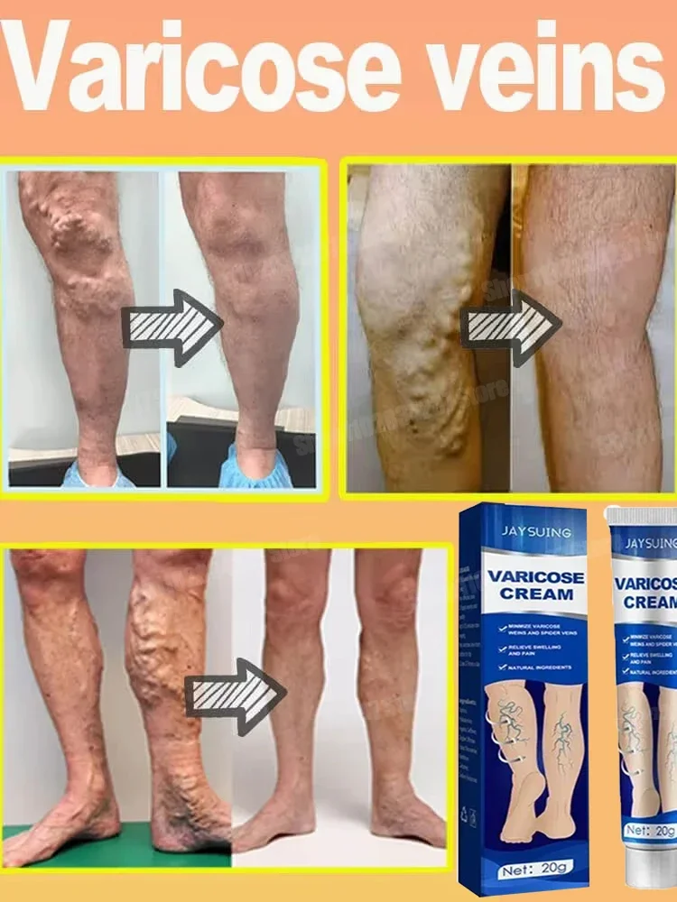 

Varicose vein treatment cream relieves leg spider pain, vasculitis, phlebitis remover, vitamin K, swelling recovery