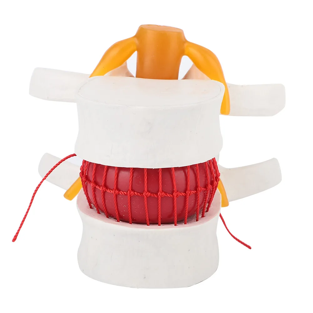 Lumbar Model 1:1.5  Vertebral Spine Human Lumbar Disc Herniation Model Demonstration Model Of Lumbar