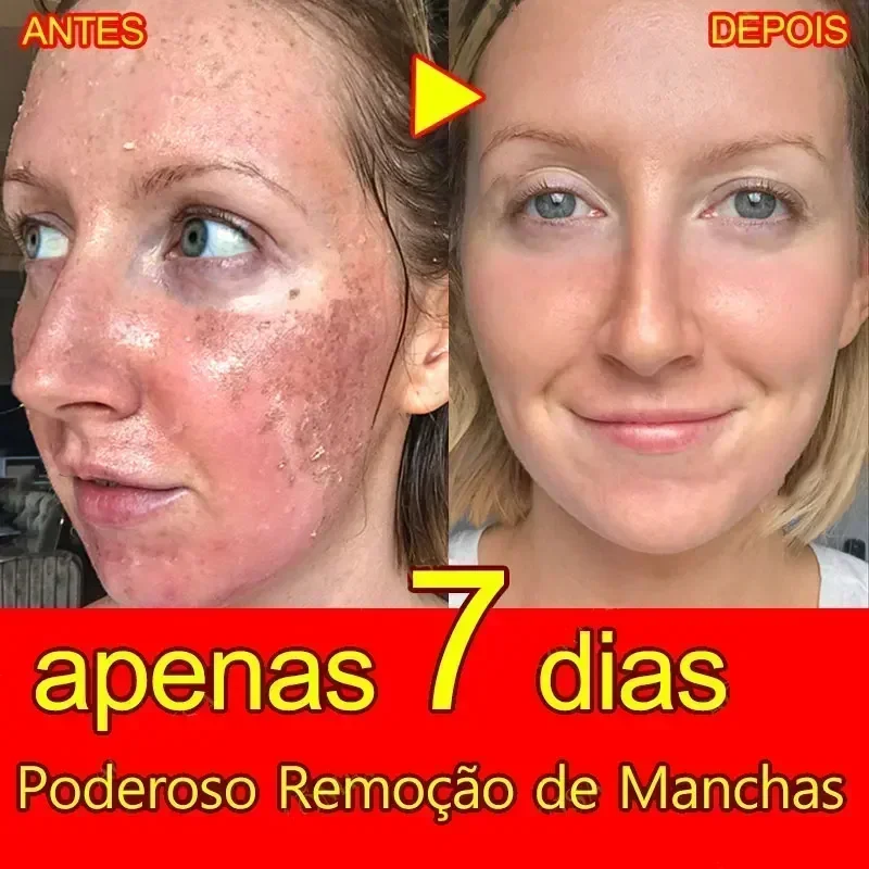 Creme De Remoção De Sardas, Remover A Mancha Escura Da Pele, Manchas De Idade De Melasma, Manchas Solares Branqueamento E Creme De Remoção De Sardas