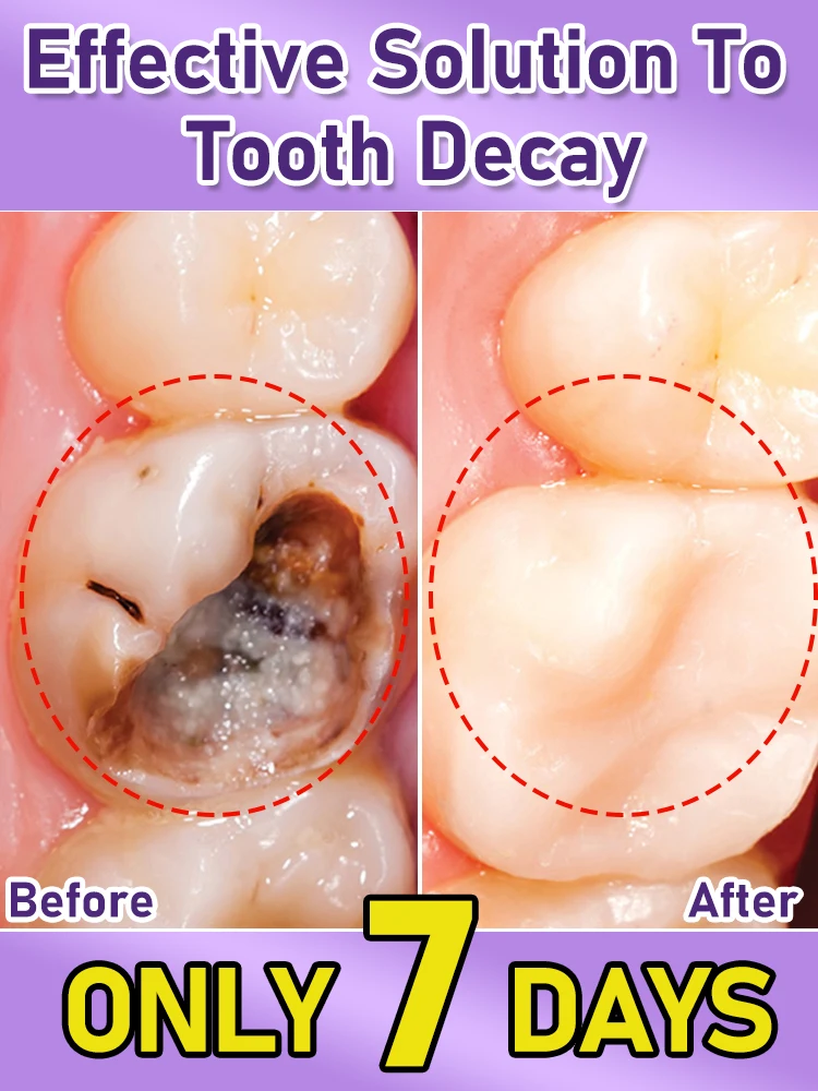 

2025 Bestseller Tooth Mousse repair tooth decay removal Unisex