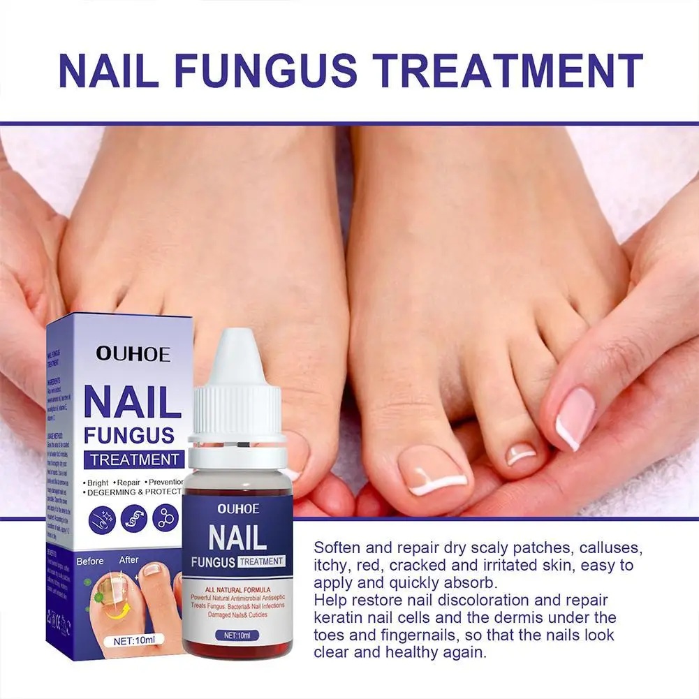 1PCS Nail Fungal Treatment Feet Care Essence Anti Infection Paronychia Onychomycosis Nail Repair Toe Fungus Serum Fungal Removal