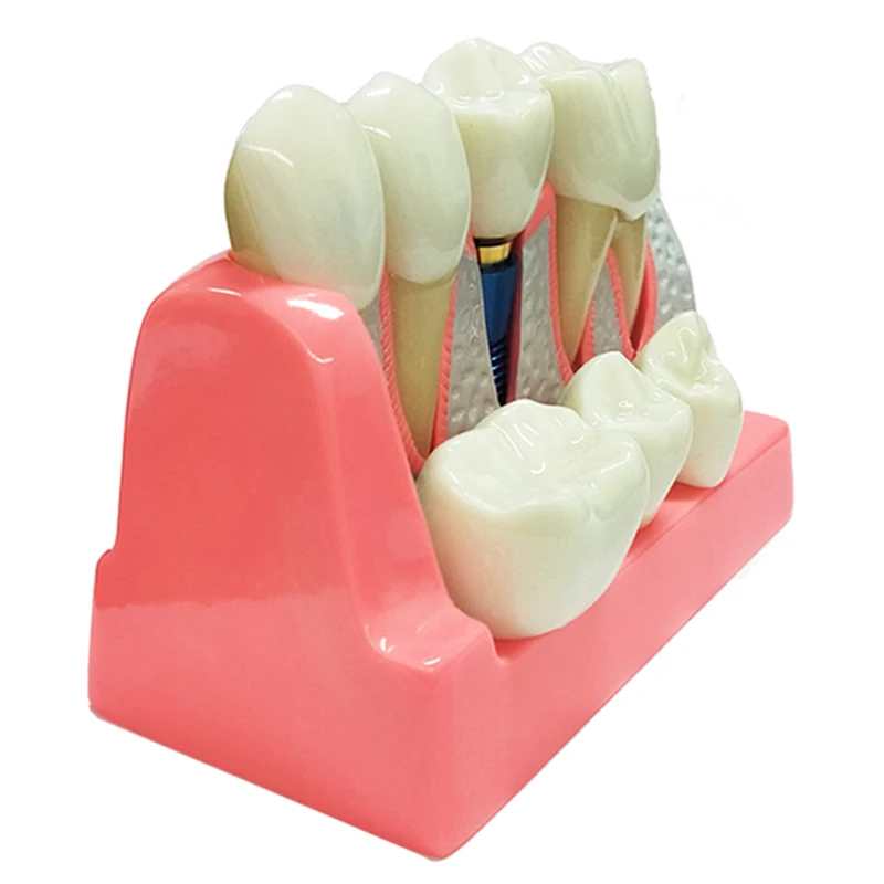 Dental Implant Model Crown Bridge Removable Porcelain Teeth Model for Dentist Teaching Model Doctor-patient Communication