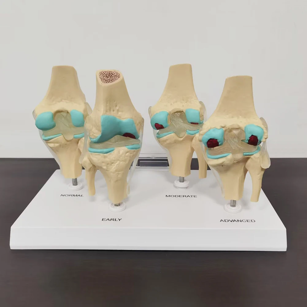 

4-stage knee joint model Plastic Bone Model Of Human Body Teaching Equipment Student Lab Medical Teaching Model PVC Model