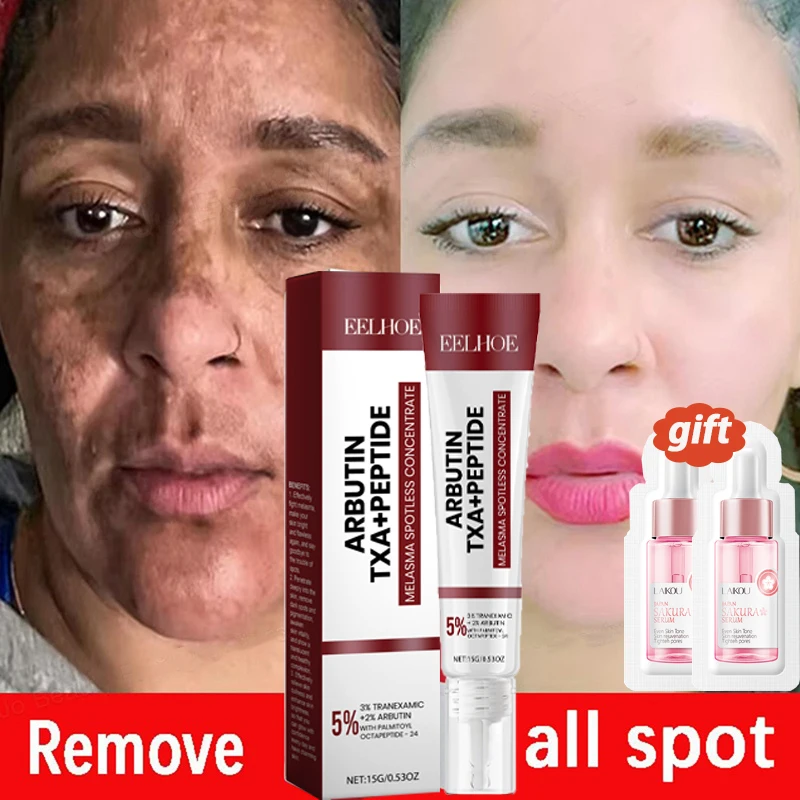 

Powerful Spot-Removing Whiten Cream Brighten Skin Fast Eliminates Melanin Pigmentation Melasma Dark Spots Korean Skin Care 20g