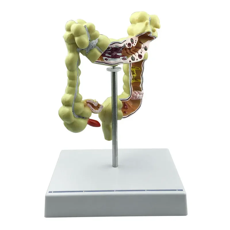 

GREATLH Colorectal Lesion Model Human Colon Snake Large Intestine Pathological Diseases Model Demonstration Human Model