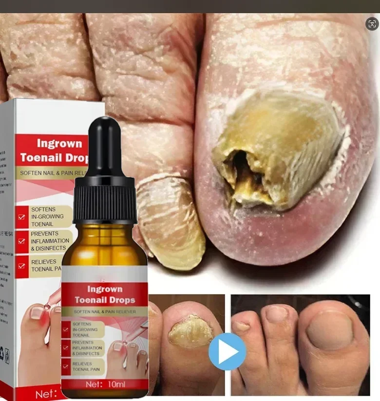 Nail fungus treatment Oil herbal nail polish foot protection skin care oil repair cream foot nail polish repair products