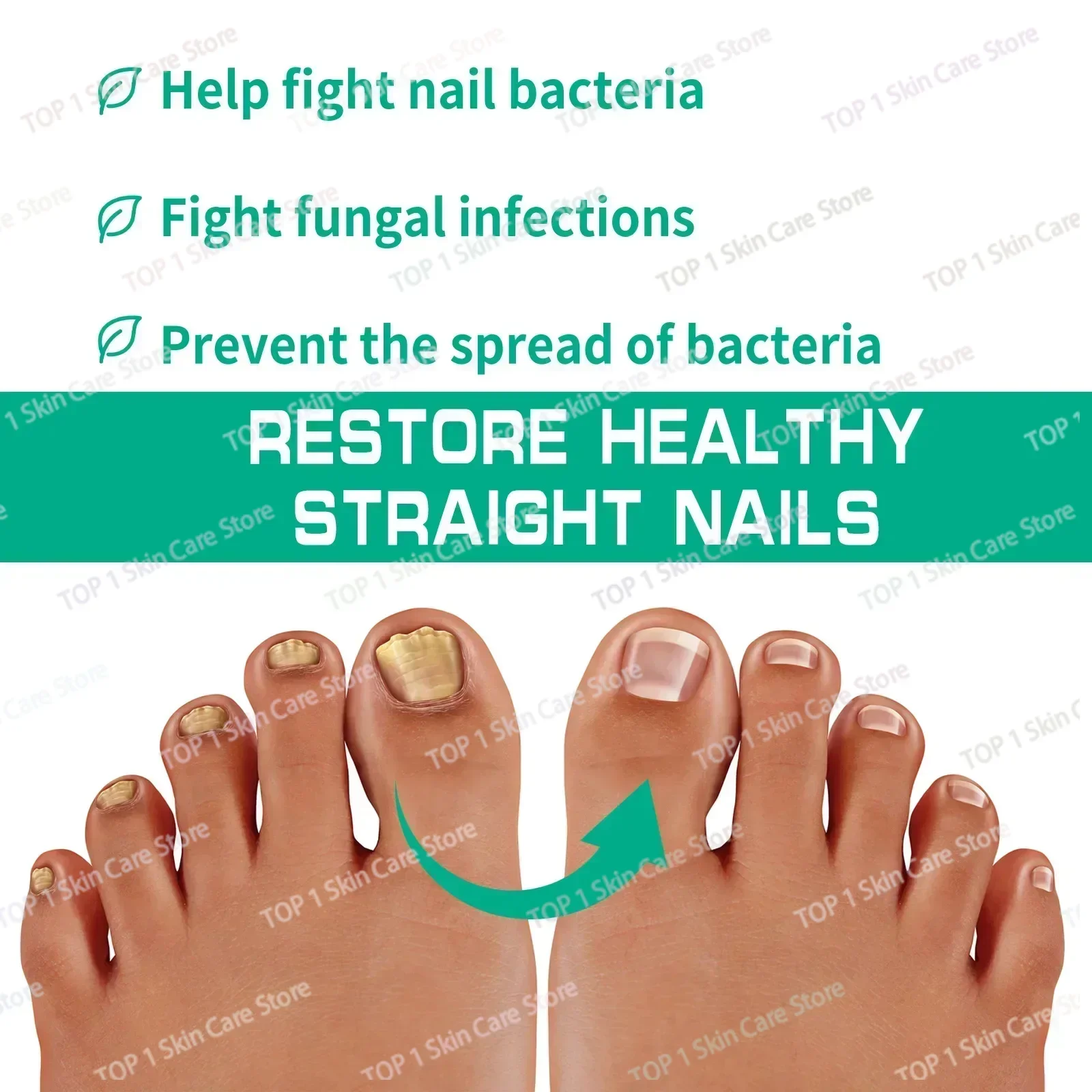 Newanti เล็บการติดเชื้อกำจัด Onychomycosis เล็บสีเทาลบลบเชื้อราคุดเล็บเท้าดูแล paronychia CRE