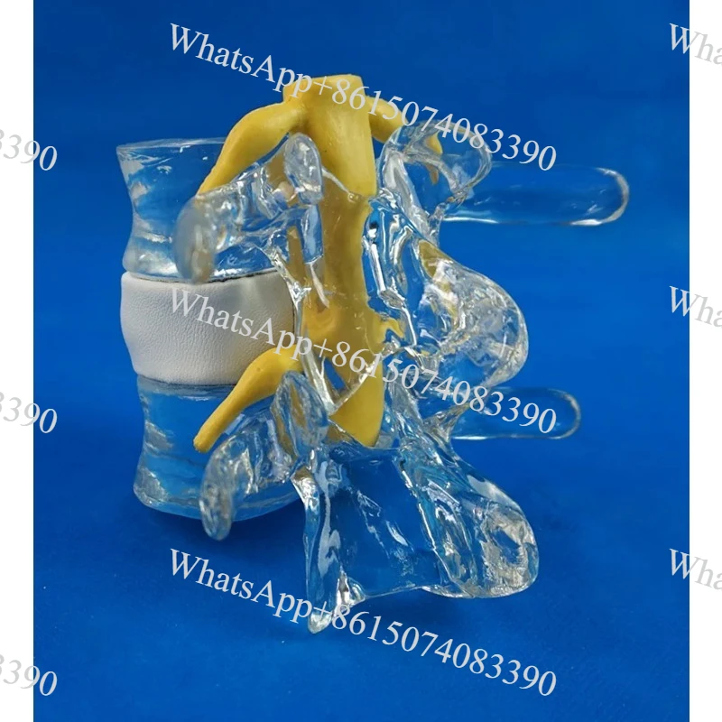 Lumbar Disc Herniation Model 1.5X Life Size for Medical Teaching