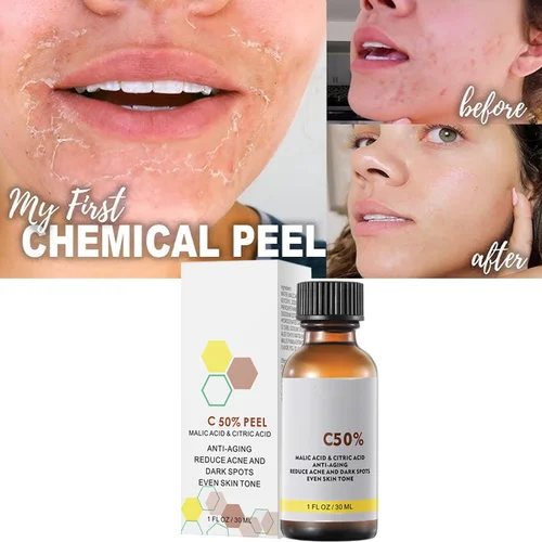 Con ácido málico y ácido cítrico para la cáscara Facial 40% suero exfoliante suero exfoliante cáscara química blanqueamiento esencia nutritiva