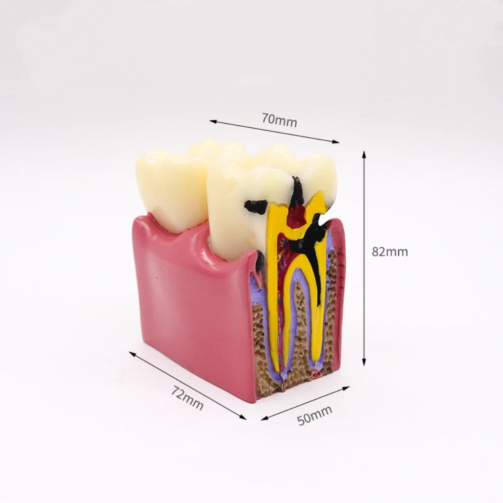 Advanced Gum Disease Demonstration Kit Shows Calculus Deposition, Pocket Formation, and Tooth Mobility