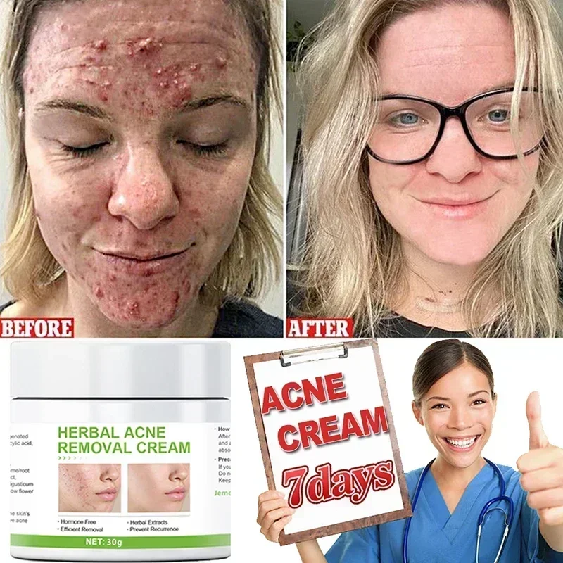 Buy 2 get 1 free Acne Removal Face Cream  Anti-Acne CreamTreatment Acne Mark Skin Care Whitening Eliminate Pimples Facial Cream