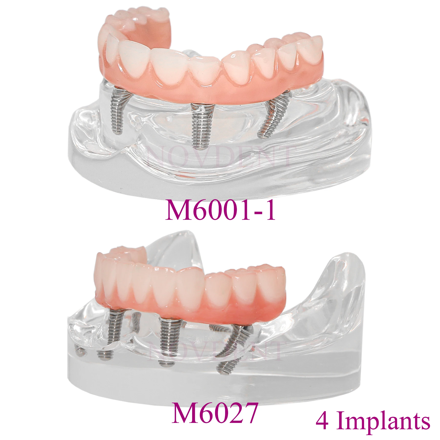 Dental Implant Teeth Model Upper/Lower Jaw 4 Implants Type All Have 4 Overdenture With 4 Removable Screws M6001-1 M6027