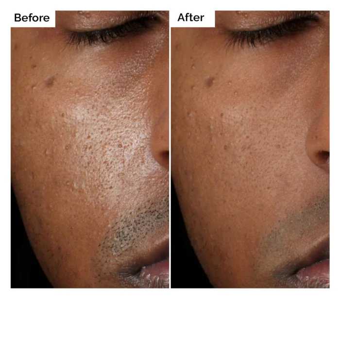 Aloe 2% + NAG 2% Solution Serum 30ml for Post-Acne Marks Improves Skin Texture Supports Strong Protective Barrier