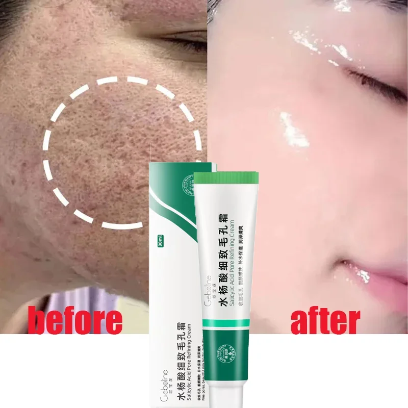 

Salicylic Acid Shrink Pore Cream Quick Elimination Large Pores Remove Blackehead Tighten Face Smooth Repairingskin Care Products