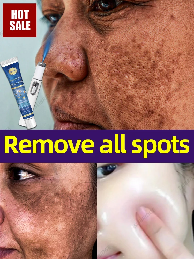 Nano laser Facial s-pots are gone