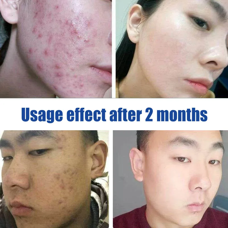 Acne Treatment Origing Serum 100% EGF Pure Natural Essence Efficiency Clearing Severe Acne Remover Pimple Repair Skin Whitening