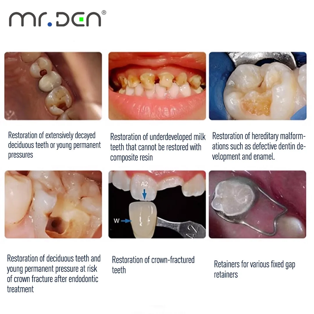 MR DEN Dental  ND 96 Assorted Primary Molar Stainless Steel Crowns Complete Kit Kids Temporary Dental Crown