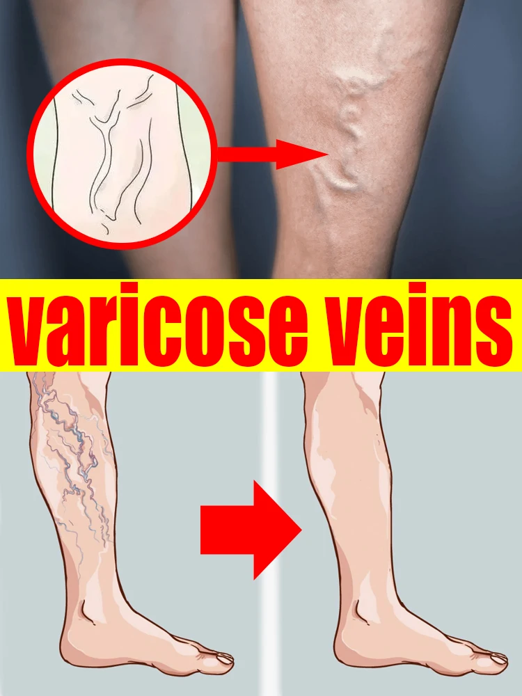 

Varicose Vein Lampshade Therapy Effective Relief Of Dilated Vasculitis In The Legs Phlebitis Improved Blood Circulation New