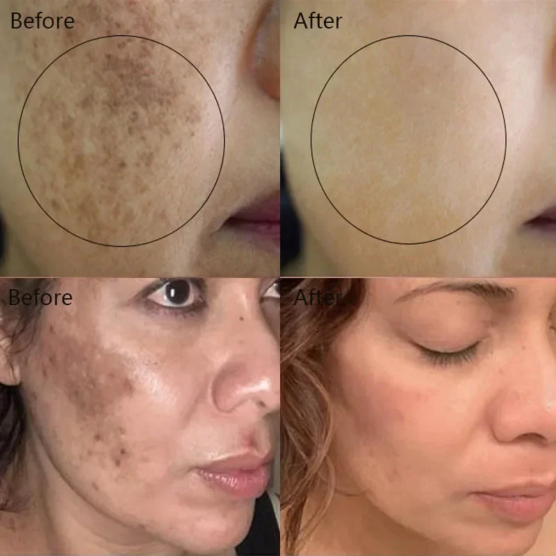 Astragalus Whitening Freckle Cream Gesicht Entfernen dunkle Flecken Melasma Aufhellen Sie Melanin Aknenarben Anti-Aging Erhellen Sie die schwarze Hautpflege