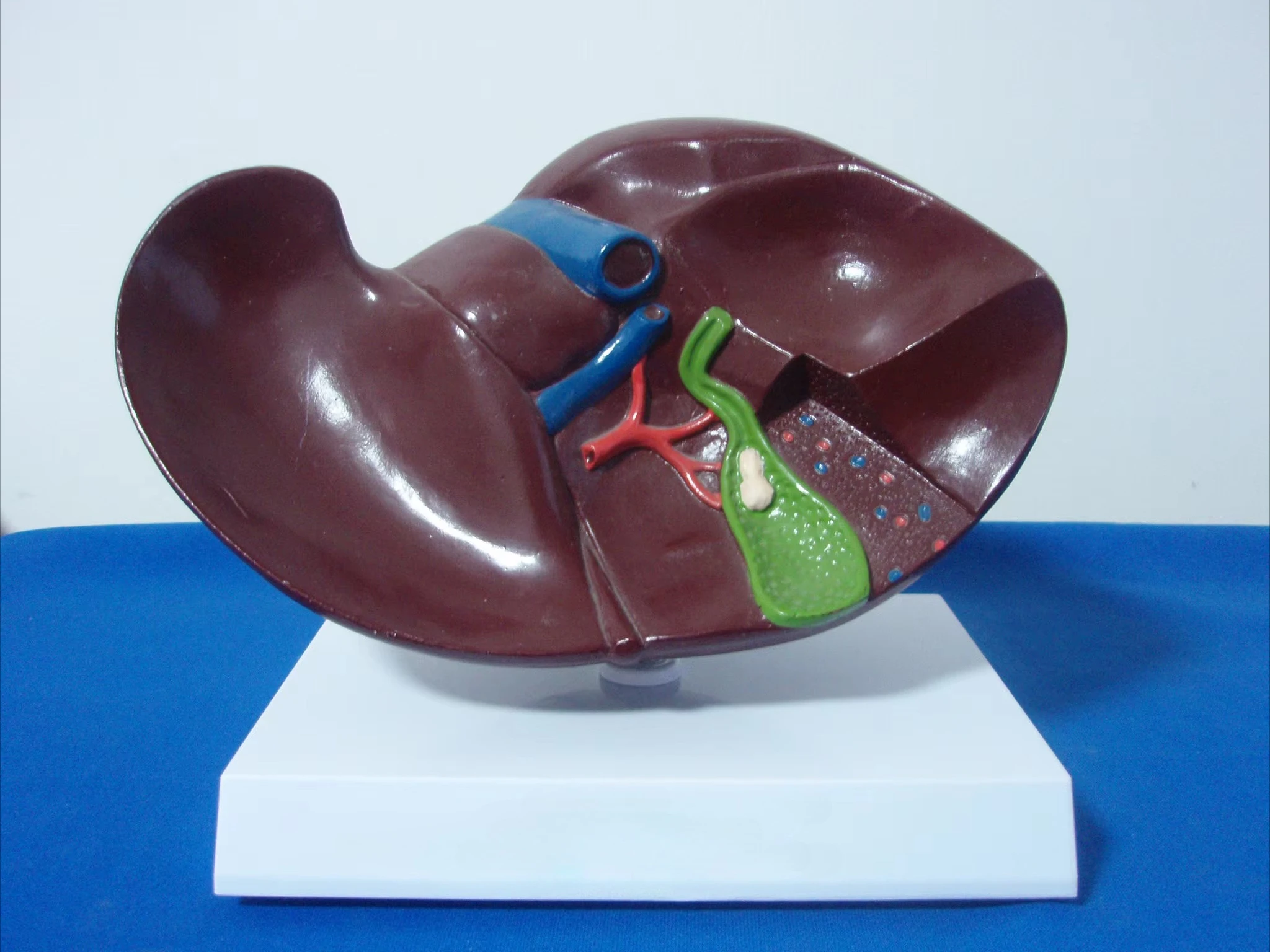 An anatomical model of chronic hepatitis for medical students with liver disease