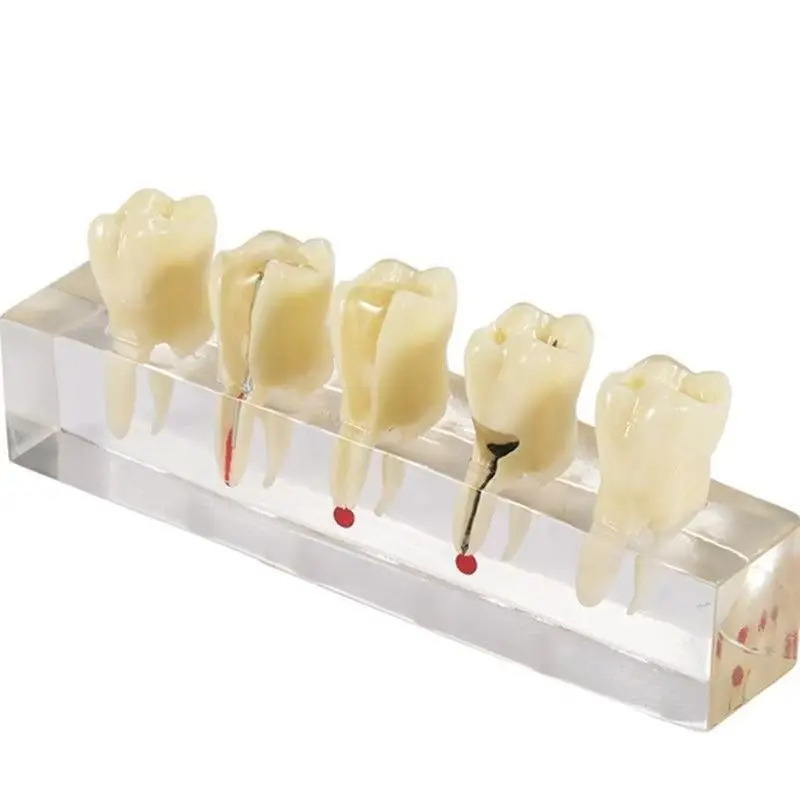 1 Set Dental Oral Root Canal Model Demonstration Tooth Decay Caries Development Teaching Practice Model For Root Canal Treatment