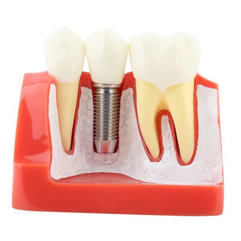 Teeth Demonstration Model Implant Removable Analysis Crown Bridge For -Patient Communication