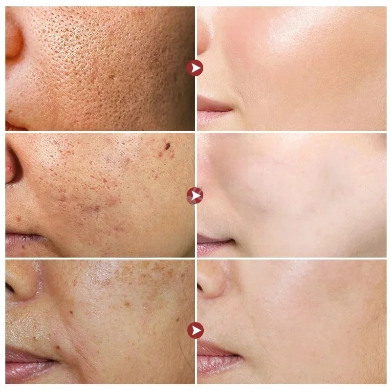 حمض الساليسيليك كريم تقليص المسام تقليل المسام الكبيرة تشديد تكرير الوجه إصلاح الخام مملة المسام سطع ترطيب العناية بالبشرة