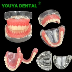 Modelo de implante Dental, producto de odontología, demostración de overdentadura Interior extraíble, mandíbula Superior e inferior con 4 implantes