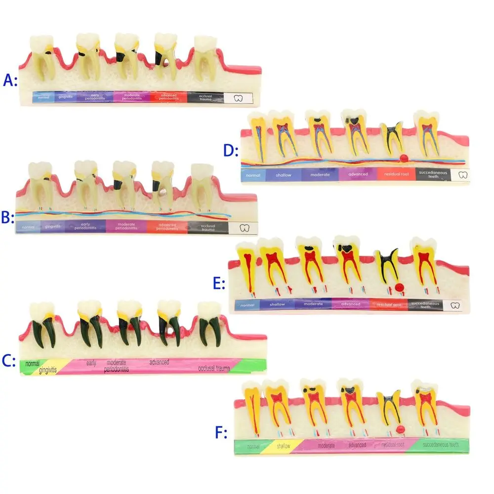 

Dental Perio Disease Assort Demo Teeth Model Caries Disease Model 5-Stage Periodontics Model