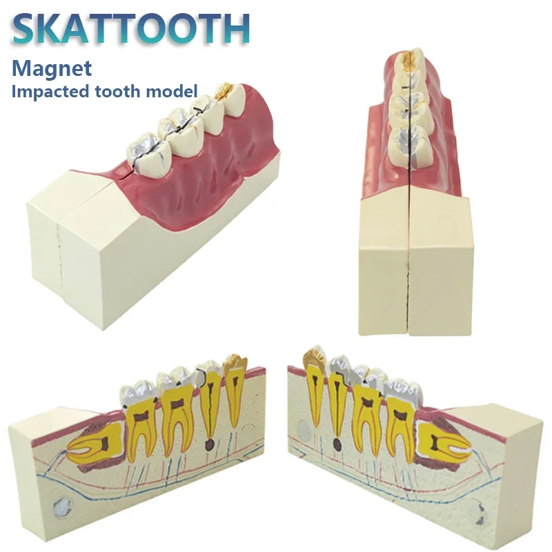 

Dental Teaching Model Repair Pathological Impacted Tooth Model Pulp for Dentist Teaching and Training Dental Magnet Dentistry