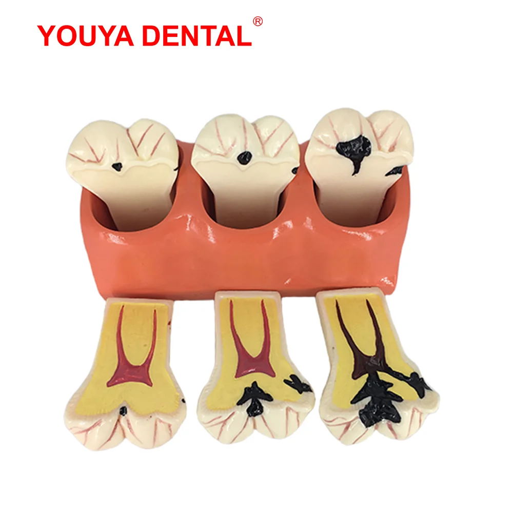 Teeth Anatomy Dental Model Teaching Study Dental Anatomical Model for Dentist Patient Education Demonstration Dentistry Products